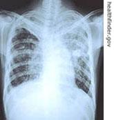 Tuberculosis is a a href=