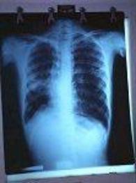 An x-ray of a patient a href=